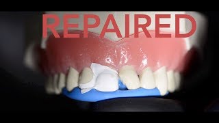 How the dentist repairs a chipped tooth [upl. by Glantz]