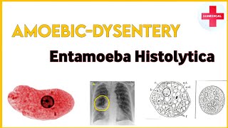 AmebiasisAmoebic dysentery Entamoeba histolytica pathogenesissign amp symptoms treatment [upl. by Nonie935]