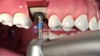 Protocole de pose de l’implant Straumann® TLX [upl. by Akyre308]