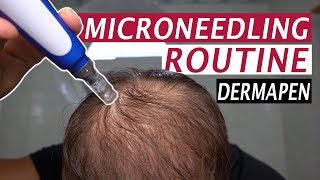 My Microneedling Routine and Derma Rolling for Hair Loss [upl. by Huntingdon]