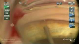 iStent Trabecular MicroBypass Implantation Ike Ahmed [upl. by Alyahc513]