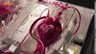 Live heart before heart surgery [upl. by Rockefeller118]