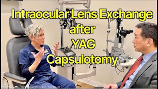 Intraocular Lens Exchange of single piece acrylic lenses after YAG capsulotomy Shannon Wong MD [upl. by Nathaniel]