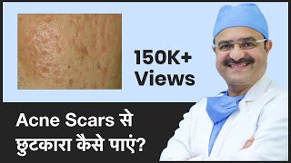 Acne Scars Causes amp How To Get Rid Of Acne Scars Acne Scars से छुटकारा कैसे पाएं In HINDI [upl. by Drofub]