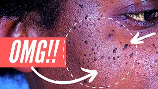 Why am I getting so many moles on my FACE Dermatosis Papulosa Nigra explained [upl. by Beshore]