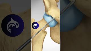 See how a Pincer Impingement of the Hip is repaired  3D Animation [upl. by Leunad320]