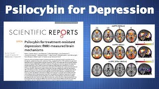 How Psilocybin Treatment Alters Brain Activity In Depressed Patients [upl. by Notled]