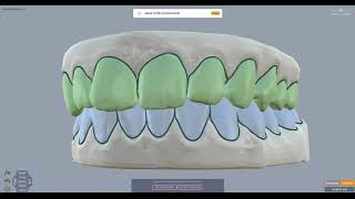 ArchForm Tutorial  How to Segment Your Scans in the Treatment Planning Software [upl. by Haveman]