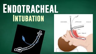 ENDOTRACHEAL INTUBATION  ET Tube Insertion [upl. by Hyams576]