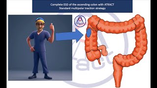 Complete ESD caecum procedure with adaptive traction [upl. by Juster]