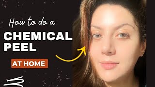 How to do Chemical Peel at Home How to do Chemical Peel Treatment at Home Chemical peel kaise karen [upl. by Yellas]