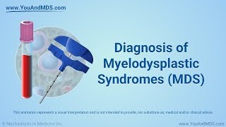 Diagnosis of Myelodysplastic Syndromes MDS [upl. by Klinges]