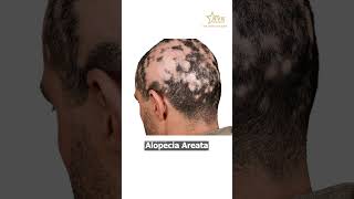 What is Alopecia Areata  How it Affects Body  DrNeelima Potluri  NVK Aesthetics [upl. by Shelburne33]