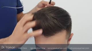 Dr Resul Yaman Hair Clinic  3870 Grafts Result [upl. by Petua]