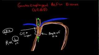 Pathophysiology of Gastroesophageal Reflux Disease GERD [upl. by Nylsirk]