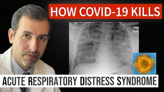 How Coronavirus Kills Acute Respiratory Distress Syndrome ARDS amp COVID 19 Treatment [upl. by Tray]