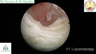 Hysteroscopic Myomectomy [upl. by Russel]