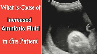 Ultrasound 8 month Pregnancy Cause of Increased Amniotic Fluid [upl. by Esenaj]