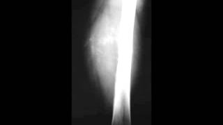 Periosteal Osteosarcoma Femur [upl. by January]