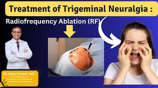 Relief from Trigeminal Neuralgia Effective Treatment with Radiofrequency Ablation [upl. by Yttiy438]