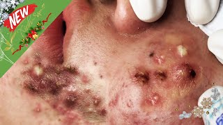 Blackheads amp Acne Treatment Hottest Videos 128 [upl. by Radec]