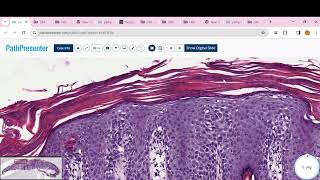 PITYRIASIS ROSEA Psoriasis clear cell acanthoma Lichen planus BLK LICHEN SCLEROSUS [upl. by Hedve]