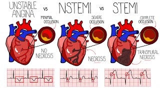 Acute Coronary Syndrome Heart Attack  Unstable Angina vs NSTEMI vs STEMI  With ECGs [upl. by Tteve]