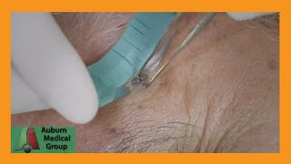 Live Facial Skin Shave Biopsy  Auburn Medical Group [upl. by Steele217]