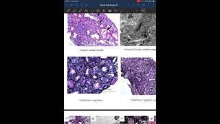 Kidney pathology part 3 [upl. by Jeralee]