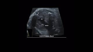 Fetal heart outflow tracks ultrasound [upl. by Ellenet]