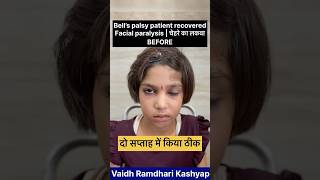 Bell’s palsy  Facial paralysis  दो सप्ताह में किया ठीक  bellspalsy facialparalysis [upl. by Annais929]