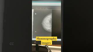 mammography images radiologycareer doctor radiologytechnologist viralshort radiographer viral [upl. by Nilya]