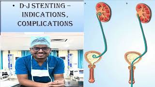 DJ STENTING  UNEDITED STEP BY STEP PROCEDURE INDICATIONS amp COMPLICATIONS [upl. by Ainer]