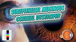 Subepithelial mucinous corneal dystrophy Your EYEBALLS 👁️👁️💉😳💊🔊💯✅ [upl. by Eissirc304]