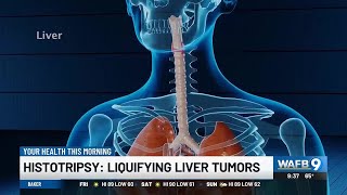 YOUR HEALTH Histotripsy Liquifying liver tumors [upl. by Gorey]