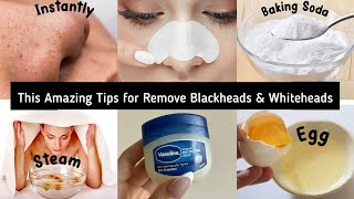 Easy to remove blackheads and whiteheads 🤯  Nose blackheads blackheads remove  whiteheads removal [upl. by Nylsor]