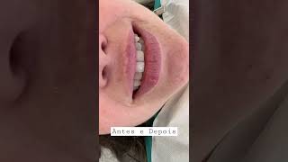 ✅Antes e depois de facetas de resina composta facetas dentistas dentes [upl. by Aiciles]