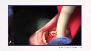 Ankylosis of Primary Tooth  The Tooth Station [upl. by Rubie250]