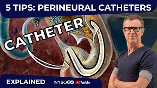 5 TIPS PERINEURAL CATHETERS  Crash course with Dr Hadzic [upl. by Dnalyram]