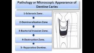 Dental CariesOral Pathology wmv [upl. by Dusty]