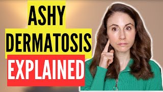 DERMATOLOGIST EXPLAINS ASHY DERMATOSIS WHAT IS IS AND HOW TO TREAT IT [upl. by Eojyllib]