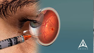 How Macular Degeneration Affects Your Vision  3D animation [upl. by Knowland]