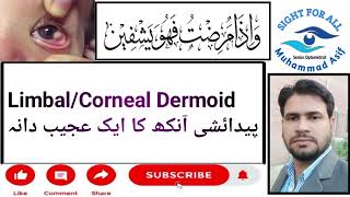 LimbalCorneal DermoidAnkho ka Paidaishi Ajeeb Dana [upl. by Tyrus]