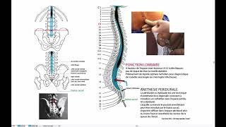 Ponction lombaire [upl. by Melia]
