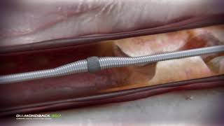 Coronary Orbital Atherectomy [upl. by Adallard931]