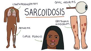 Understanding Sarcoidosis A Visual Guide for Students [upl. by Elocon476]