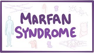 Marfan Syndrome  causes symptoms diagnosis treatment pathology [upl. by Ayojal]