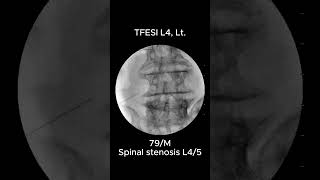 How to Accurately Perform L4 Transforaminal Epidural Steroid Injection TFESI 4 [upl. by Evod]