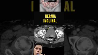 Hernia inguinal directa vs indirecta medicina cirugiageneral cirugia radiologia [upl. by Marks184]