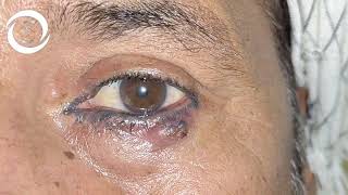 Ophthalmic Signs Eyelids [upl. by Hereld534]